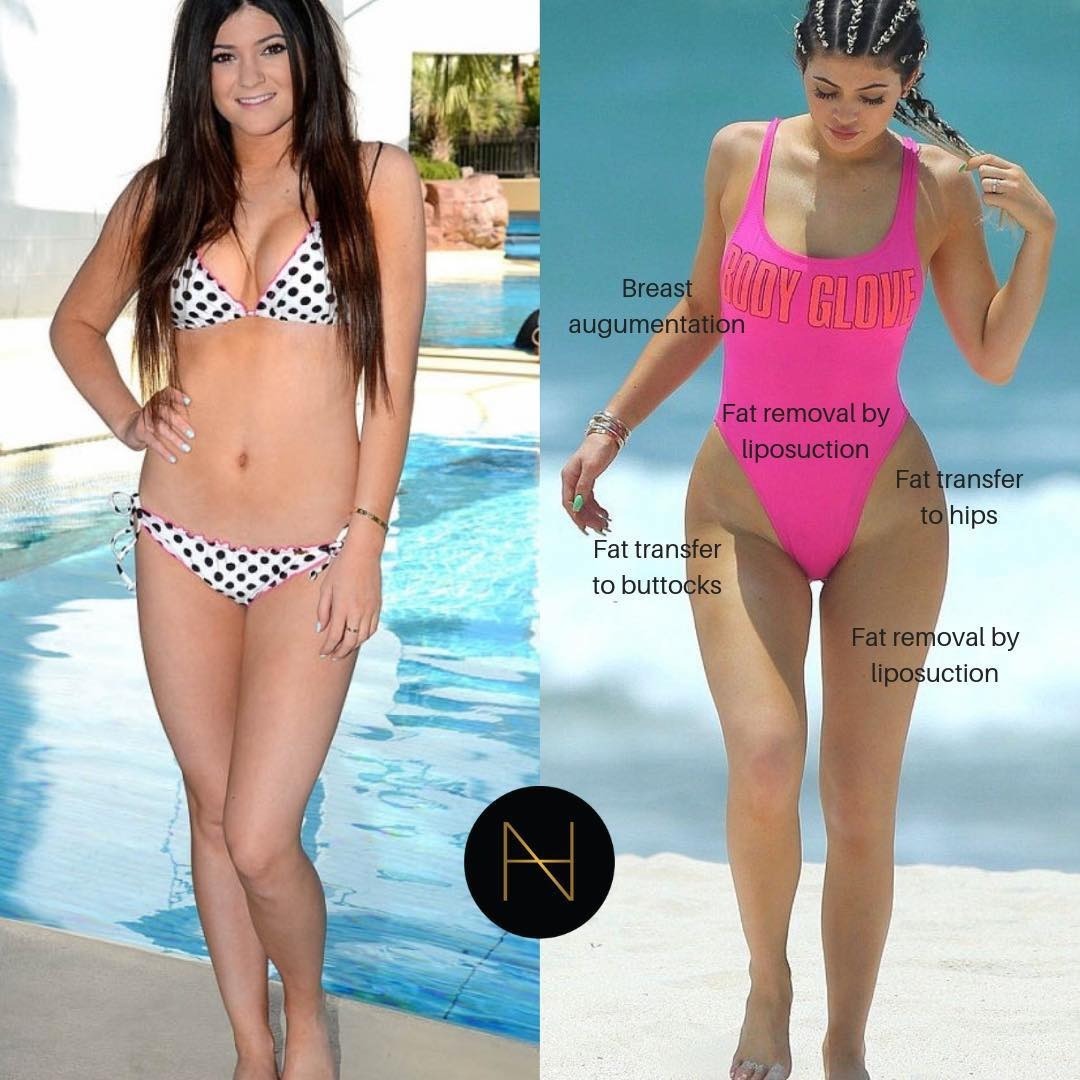 Các bộ phận cơ thể được chỉnh sửa của Kylie