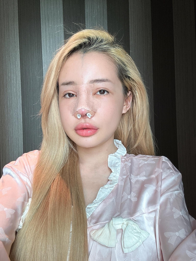 Các lần phẫu thuật thẩm mỹ của Ngân 98